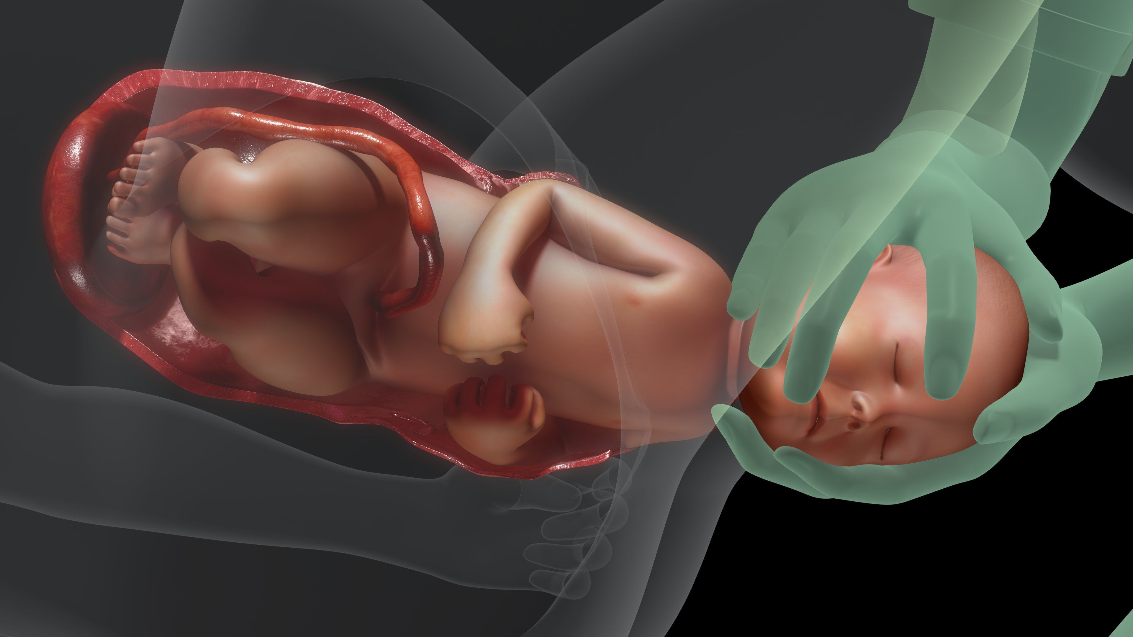 Illustration of a doctor pulling baby from the birth canal by the head